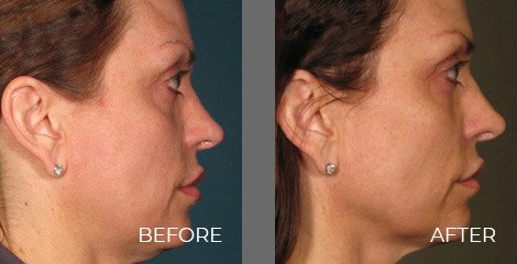 Pre-Treatment and Post-Treatment: 360 Days