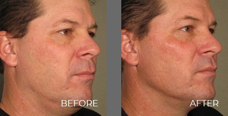 Pre-Treatment and Post-Treatment: 120 Days