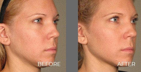 Pre-Treatment and Post-Treatment: 120 Days