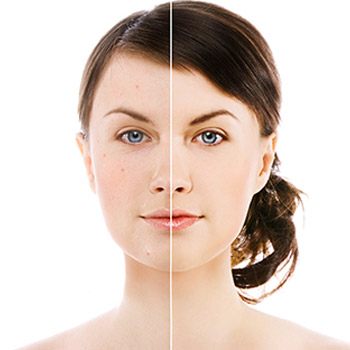 Walnut Creek patient’s restore appearance, confidence with comfortable acne scar removal