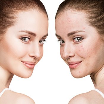 What acne scar treatments might Walnut Creek area dermatologist recommend?
