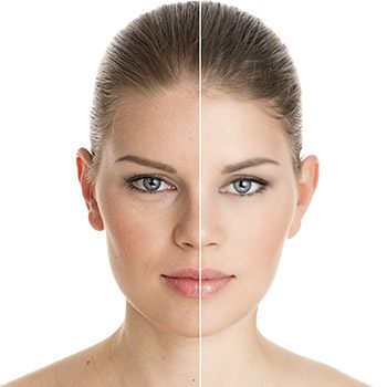 What can Walnut Creek area patients expect before and after Ulthera treatment?