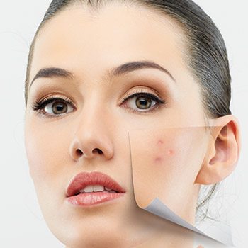 Bay Area patients ask, do fillers work for acne scars?