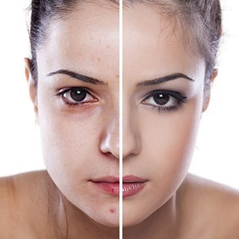 Know the facts; get help at the East Bay acne clinic