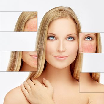 Lafayette area dermatologist describes the removal of acne scars
