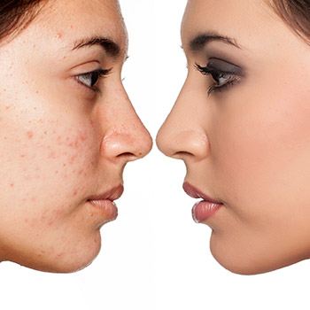 How Bay Area patients can seek treatment for pimple scars