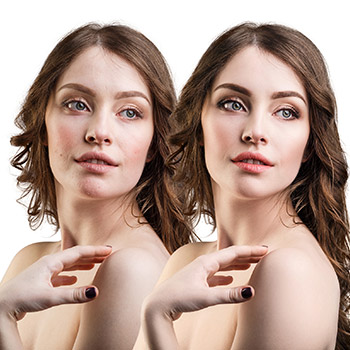 What can a Lafayette area patient expect during Ultherapy treatment?