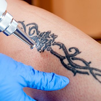 What is the best way for CA area residents to remove a tattoo?