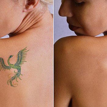 Pleasant Hill dermatologist describes how to remove tattoos