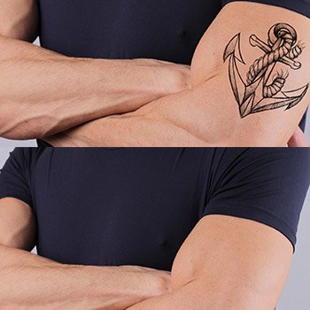 Walnut Creek area dermatologist describes laser tattoo removal