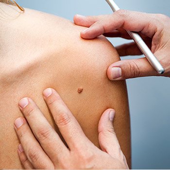 Exploring skin cancer treatment with your Walnut Creek dermatologist