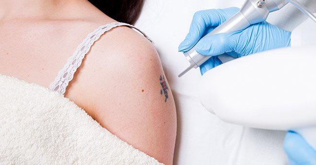 Laser Tattoo Removal, Walnut Creek, California