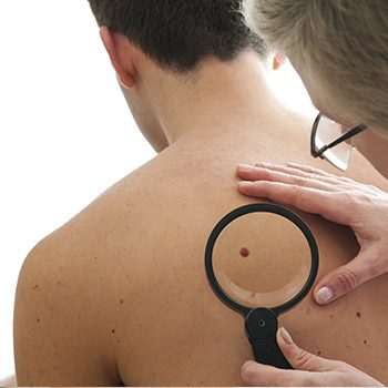 Finding a Mohs surgery specialist near me in the East Bay community