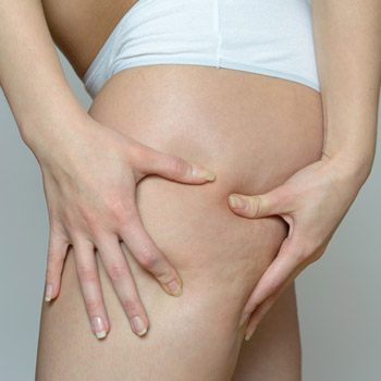 Why might an East Bay area patient consider Cellulaze treatment?