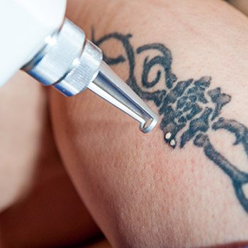 Patients in Walnut Creek looking for tattoo removal can enjoy laser treatment for amazing results!