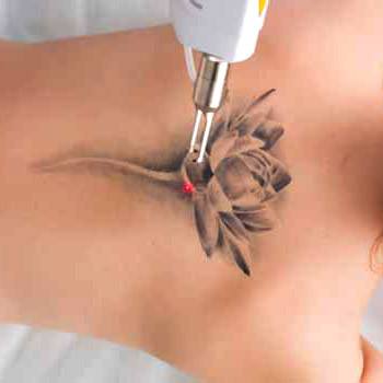 Treatment for unwanted tattoos available in Walnut Creek, CA with safe laser removal