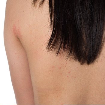 East Bay dermatologist offers may proven, precise ways to treat skin cancer