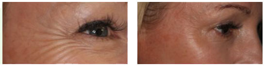 Botox and Dermal Fillers - Botox and Dermal Fillers 01