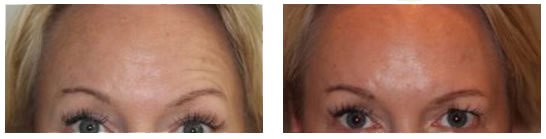 Botox and Dermal Fillers - Botox and Dermal Fillers 02