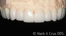 <?php echo $pk;?> - Veneers on stone cast prior to delivery