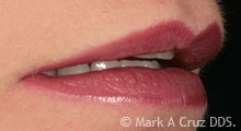 <?php echo $pk;?> - Natural lip support with new veneers