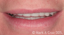 <?php echo $pk;?> - Inadequate display of lower teeth