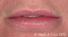 <?php echo $pk;?> - Lack of lip support from old veneers