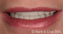 <?php echo $pk;?> - Attractive lip support during half smile with new veneers
