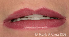 <?php echo $pk;?> - More youthful lip support with new veneers