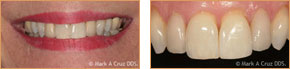 <?php echo $pk;?> - Veneers Case 01