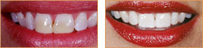 <?php echo $pk;?> - Veneers Case 02