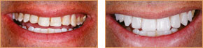 <?php echo $pk;?> - Veneers Case 03