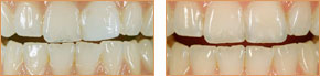 <?php echo $pk;?> - Veneers Case 04