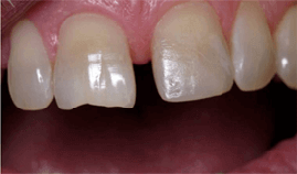 <?php echo $pk;?> - Broken tooth restored with composite After