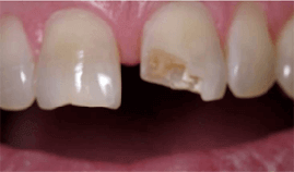 <?php echo $pk;?> - Broken tooth restored with composite Before