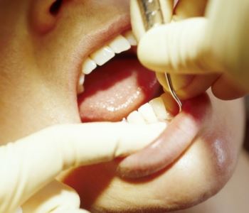 Deep Gum Cleaning from dentist in Palm Beach Gardens
