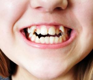 West Palm Beach area patients ask, can gum infection treatment be done without antibiotics?