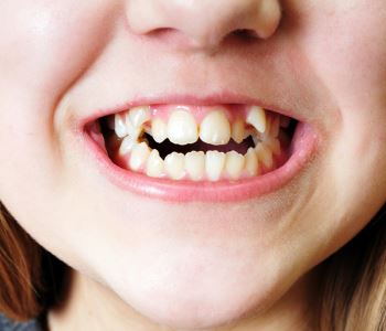 Gum Infection Treatment Without Antibiotics from dentist in West Palm Beach