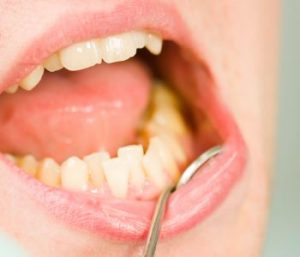 West Palm Beach area patients ask about the cost of periodontal treatment