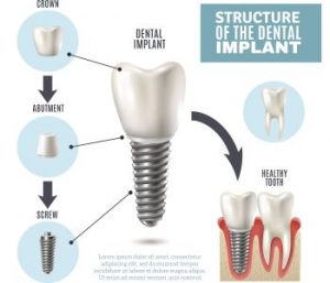 What is the process of placing dental implants at a dental practice near me in West Palm Beach?