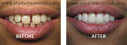 Braces Before After Case 01