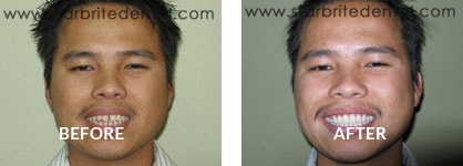 Braces Before After Case 07