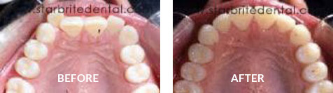 Invisalign Before After Case 01