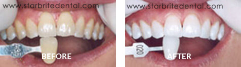 Teeth Whitening Before After Case 06