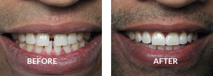 Veneers Before After Case 01