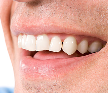 Dr Munira Lokhandwala, Starbrite Dental, Providing affordable dental veneers