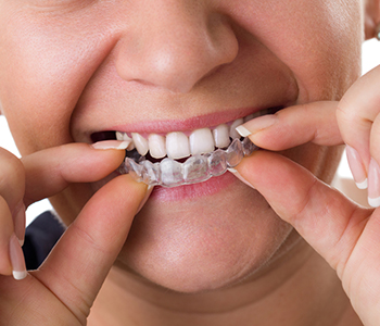 Dr Munira Lokhandwala, Starbrite Dental, Providing Affordable Invisalign