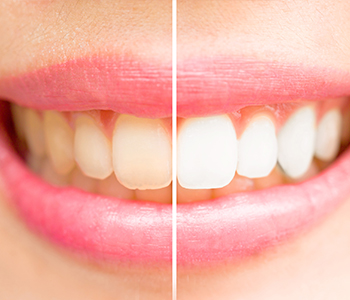 Dr Munira Lokhandwala, Starbrite Dental, Providing Best Teeth Whitening System