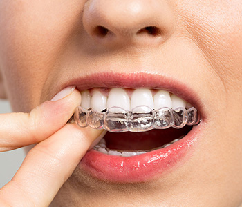 Dr Munira Lokhandwala, Starbrite Dental, Smiling Woman with silicone trainer close up