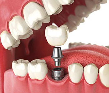 Dr Munira Lokhandwala, Starbrite Dental, Providing full dental implants
